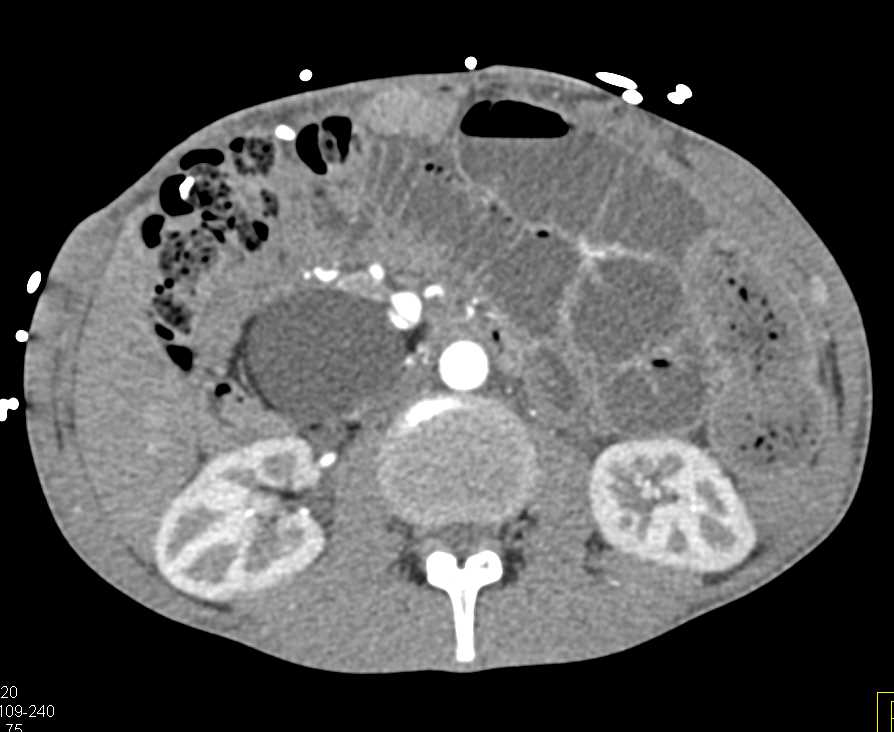 Dermoid Tumor Near the Head of the Pancreas - CTisus CT Scan