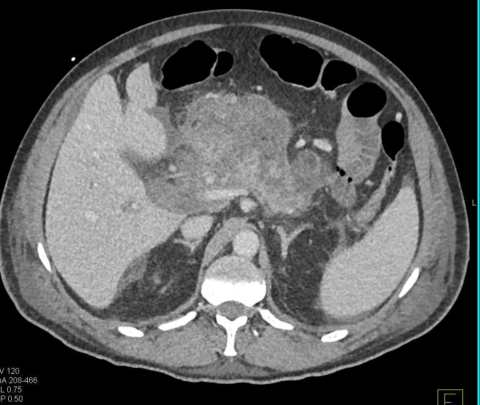 Acute Pancreatitis with Inflammation Around Pancreas - CTisus CT Scan