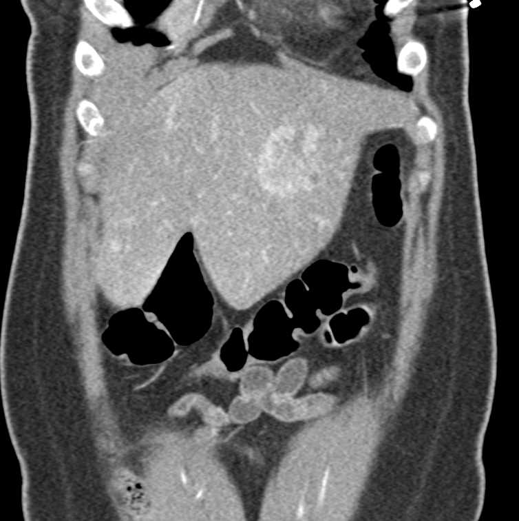 Neuroendocrine Tumor of the Pancreas with Liver Metastases - CTisus CT Scan