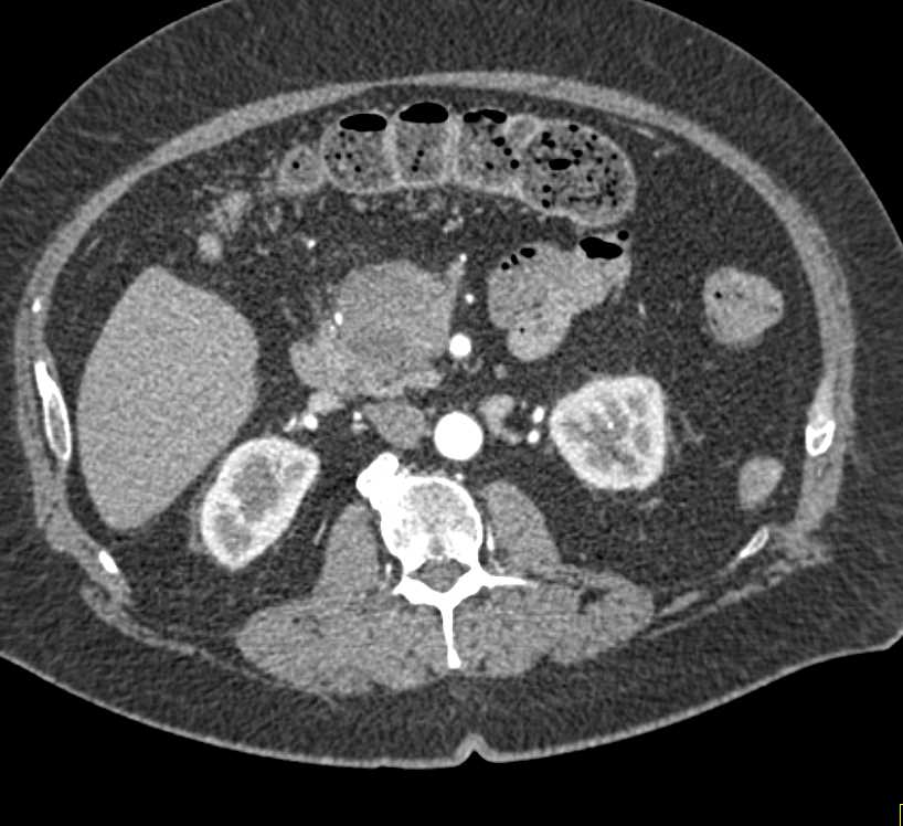 Carcinoma of the Head of the Pancreas - CTisus CT Scan