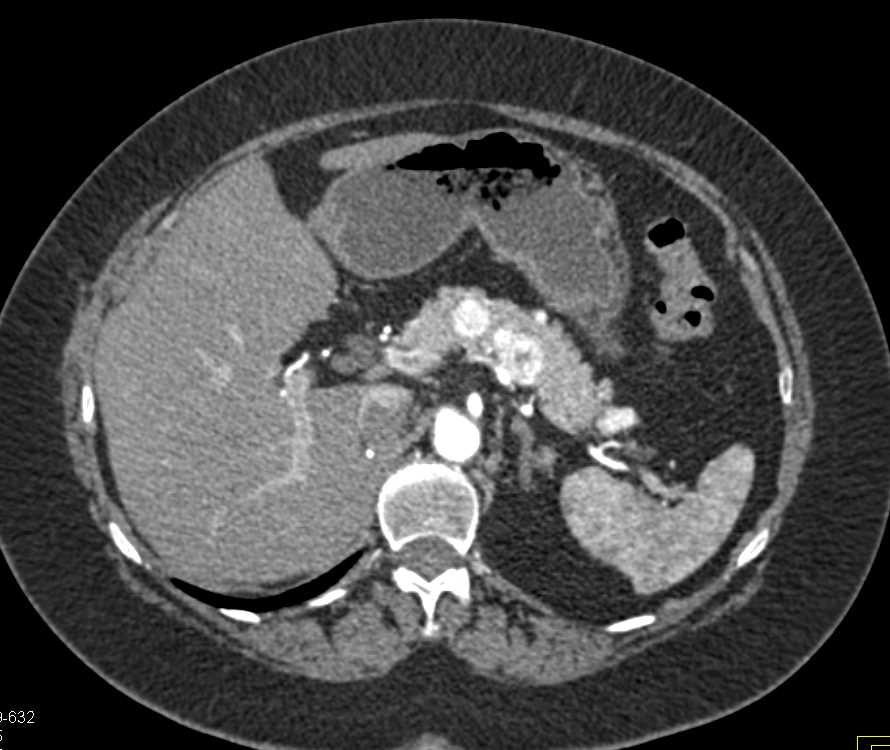 Recurrent Renal Cell Carcinoma Metastatic to the Pancreas - CTisus CT Scan