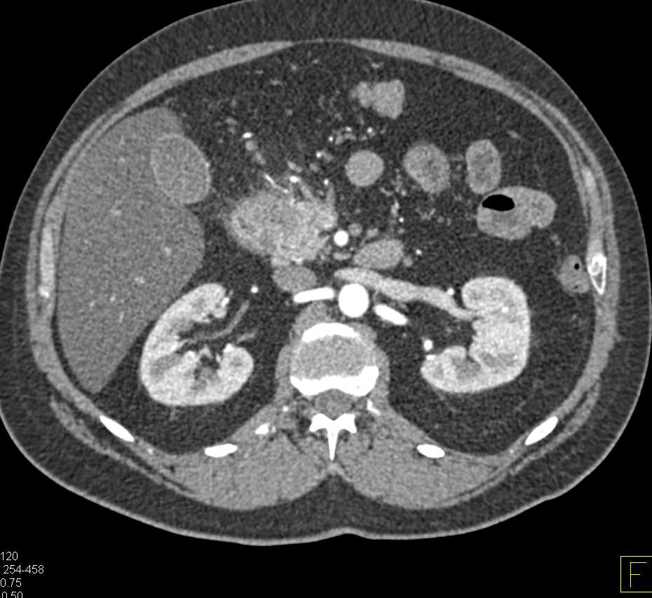 Adenocarcinoma of the Head of the Pancreas - CTisus CT Scan