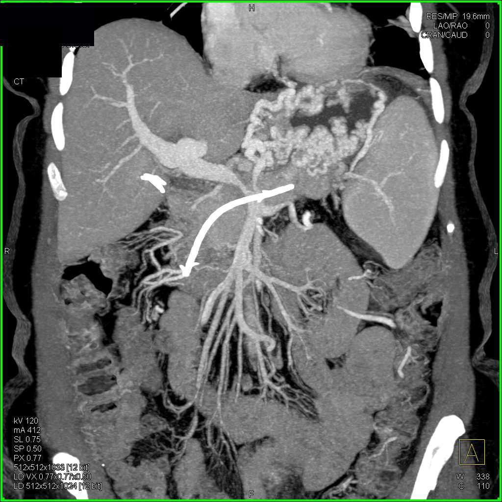 Infiltrating Pancreatic with Venous Encasement and Collaterals - CTisus CT Scan