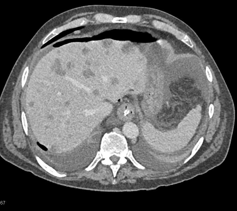 Pneumoperitoneum in Patient with Pancreatic Cancer and Liver Metastases - CTisus CT Scan