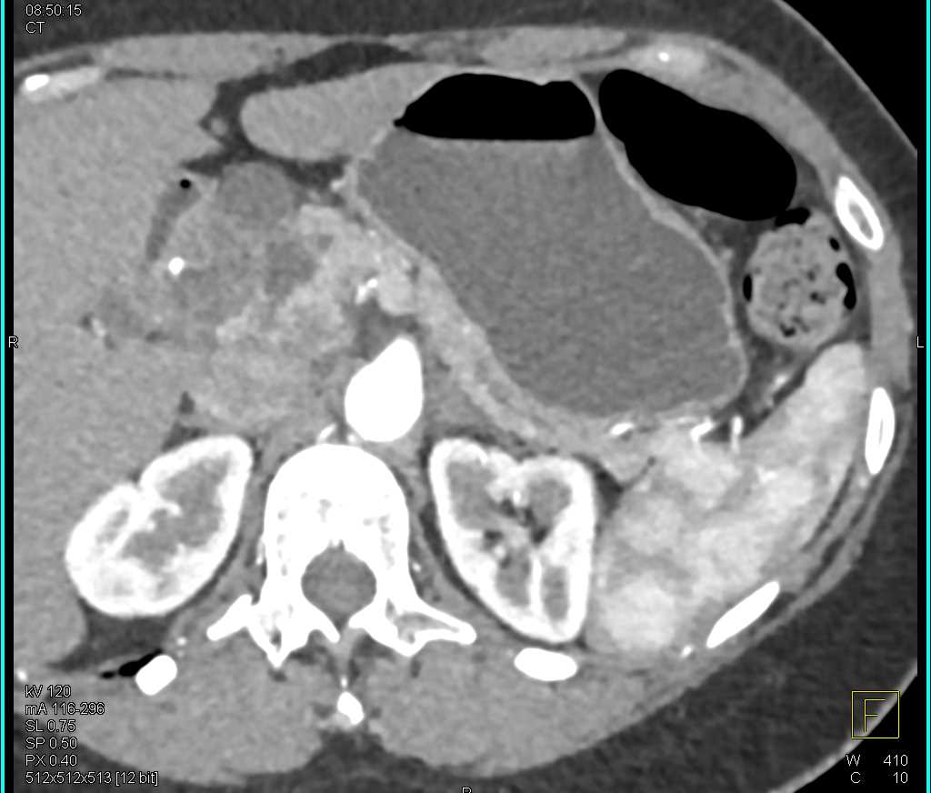 Serous Cystadenoma in the Head of the Pancreas - CTisus CT Scan