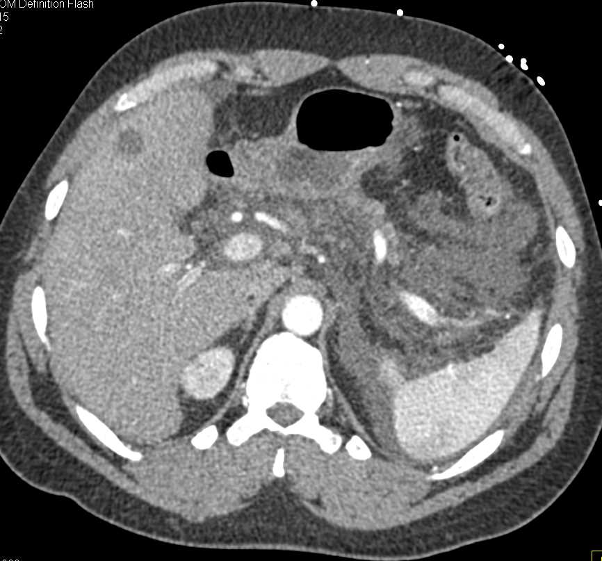 Acute Pancreatitis with Peripancreatic Fluid - CTisus CT Scan