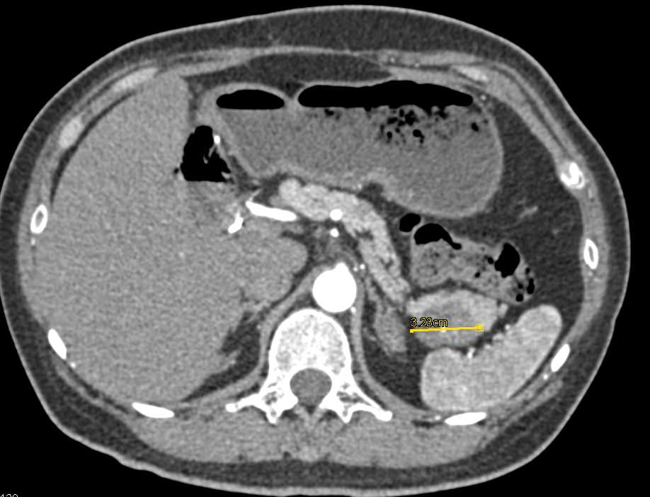 Carcinoma Tail of the Pancreas - CTisus CT Scan