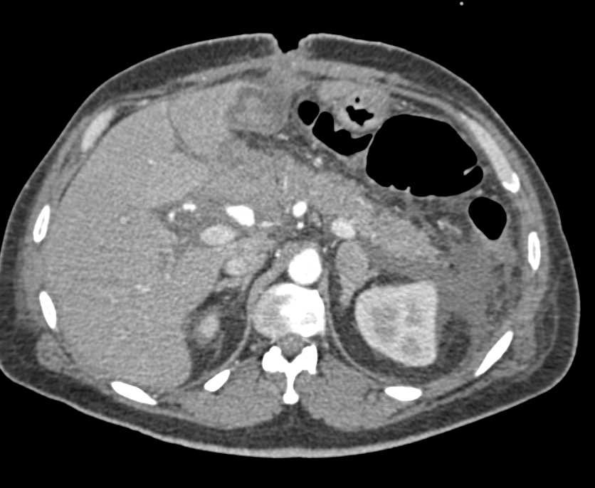 Pseudoaneurysm Gastroduodenal Artery (GDA) in Post Whipple Patient - CTisus CT Scan