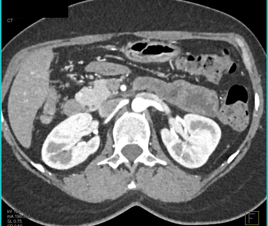 Incidental Under 1cm Neuroendocrine Tumor of the Pancreas - CTisus CT Scan