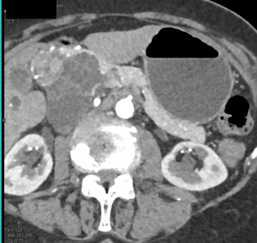 Serous Cystadenoma Pancreas - CTisus CT Scan