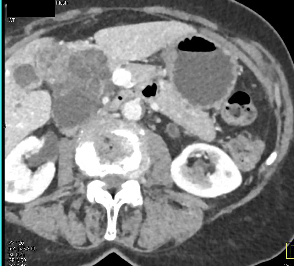 Serous Cystadenoma Pancreas - CTisus CT Scan