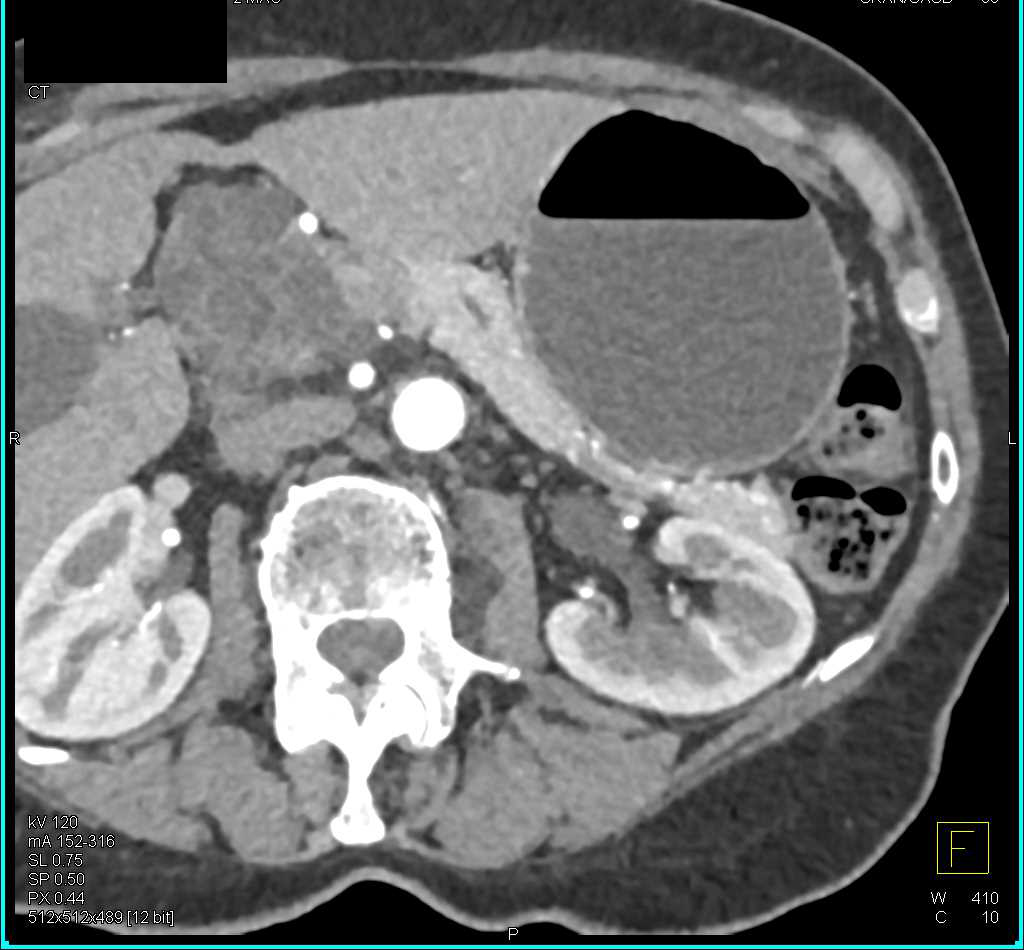 Serous Cystadenoma Pancreas - CTisus CT Scan