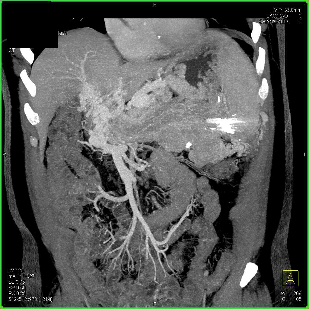 Neuroendocrine Tumor Tail of the Pancreas Involves the Spleen - CTisus CT Scan