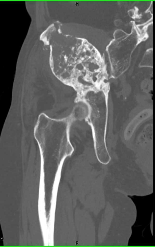 Malignant Giant Cell Tumor Right Iliac Wing - CTisus CT Scan