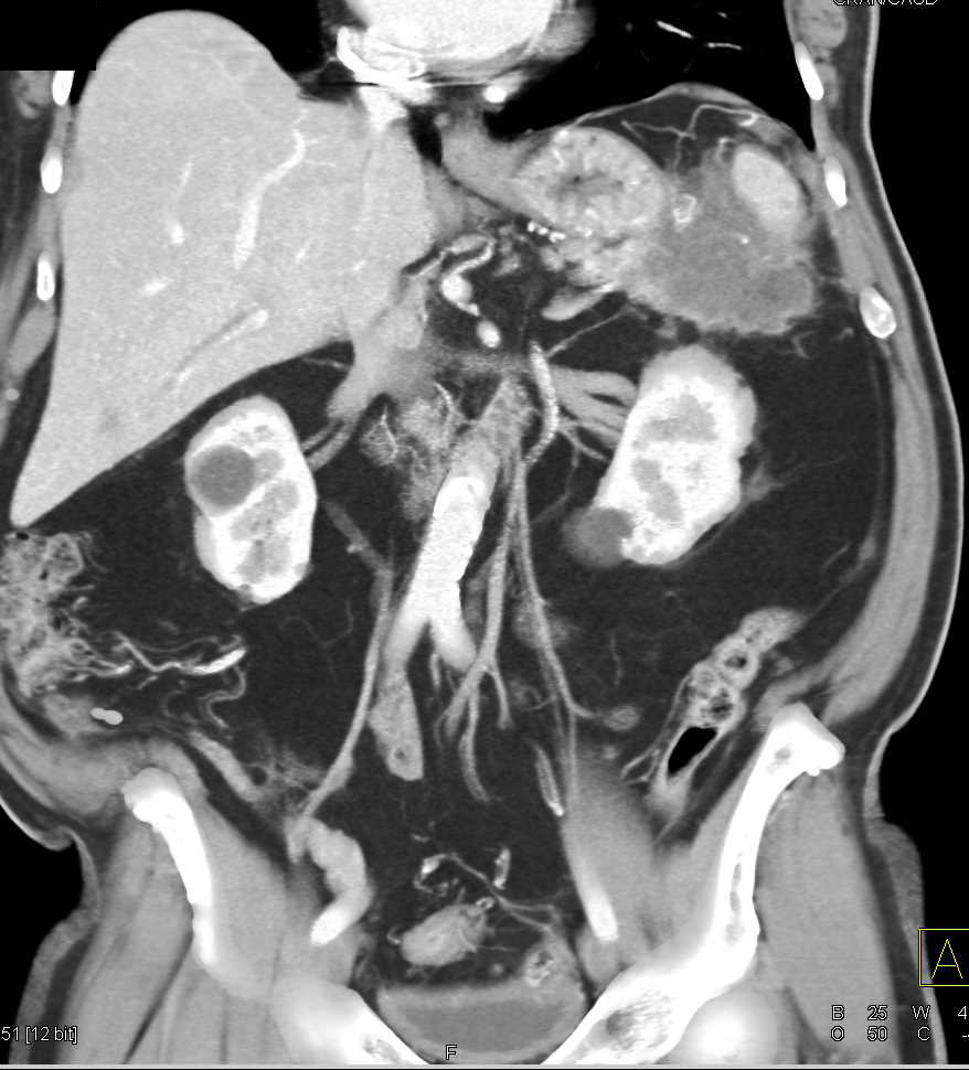 Pancreatic Cancer Invades the Spleen - CTisus CT Scan