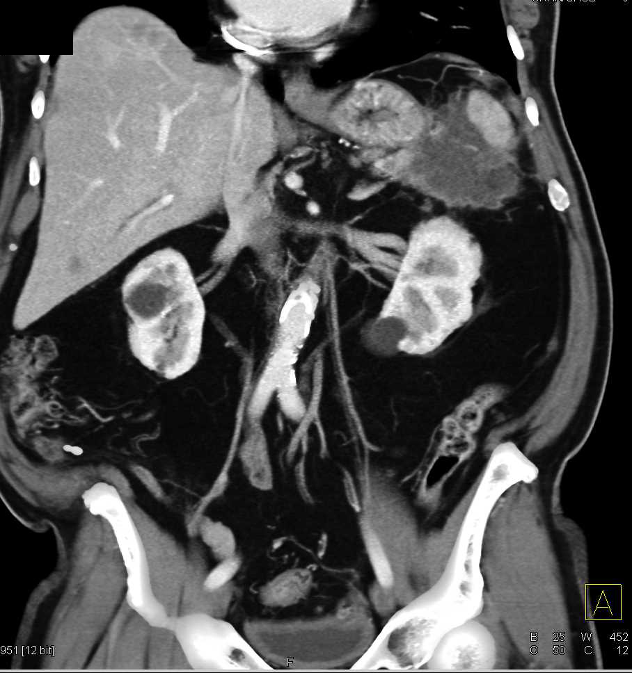 Pancreatic Cancer Invades the Spleen - CTisus CT Scan
