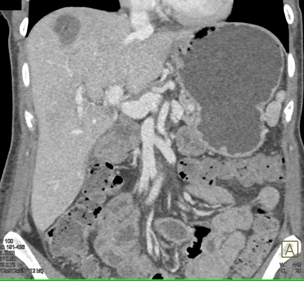 Pancreatic Cancer and Vascular Invasion - CTisus CT Scan