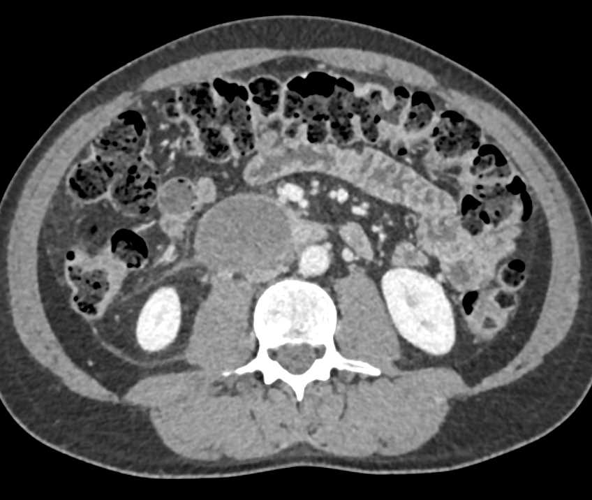 Pancreatic Cancer with Tumor Spread - CTisus CT Scan