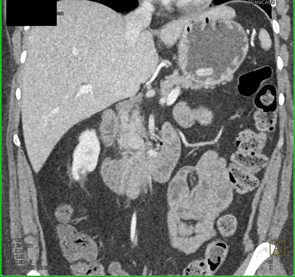 Neuroendocrine Tumor Near Uncinate Process - CTisus CT Scan