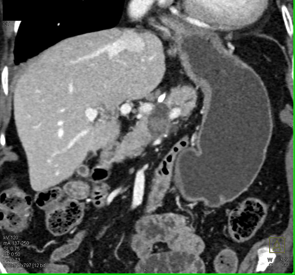 Subtle Low Density Pancreatic Cancer - CTisus CT Scan