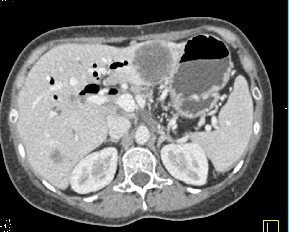 Metastatic Pancreatic Cancer to the Liver - CTisus CT Scan