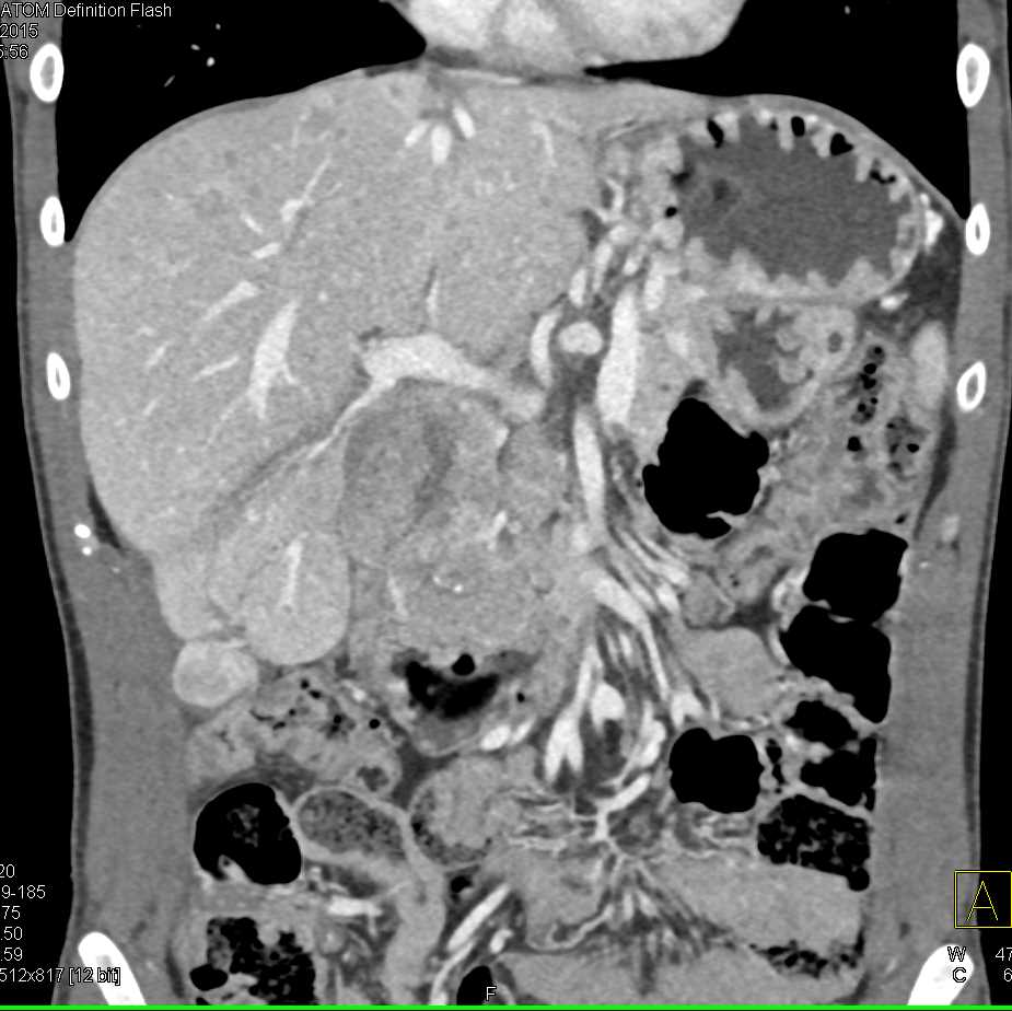 Metastatic Neuroendocrine Tumor - CTisus CT Scan