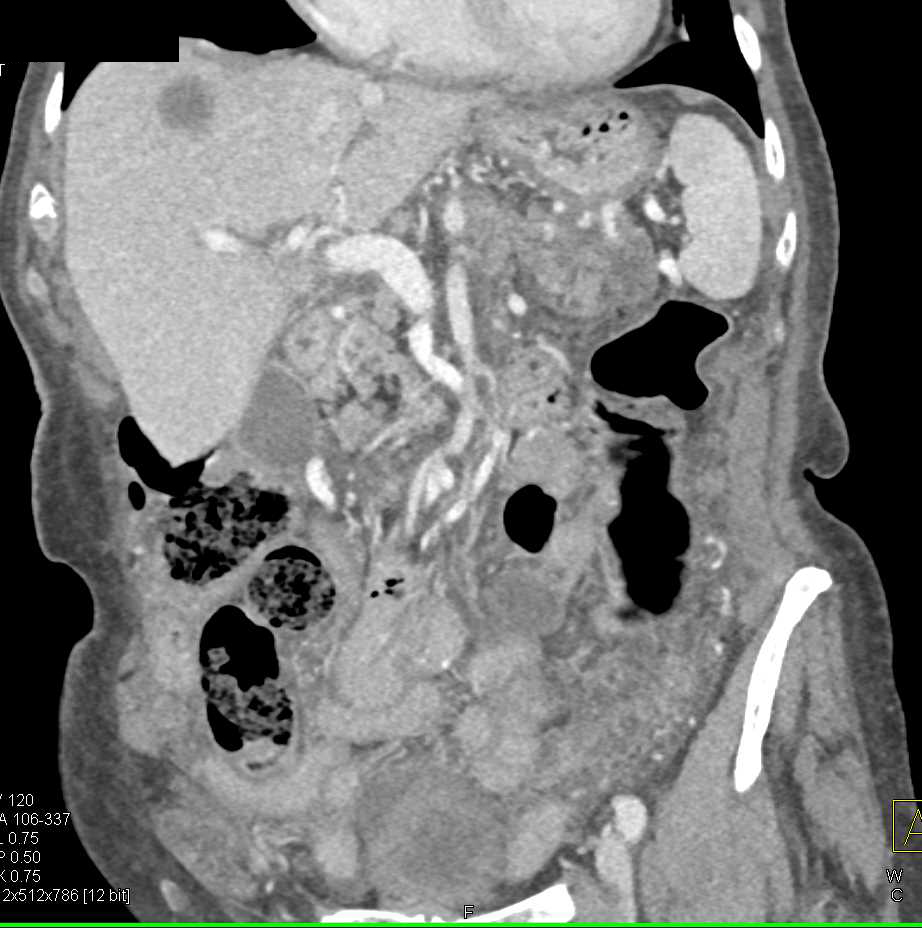 Pancreatic Cancer with Liver Metastases - CTisus CT Scan