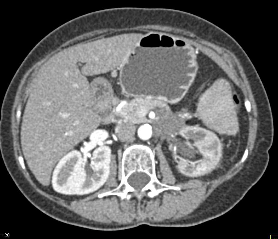 Pancreatic Cancer Invades Duodenum and Left Kidney. Stent in Duodenum - CTisus CT Scan