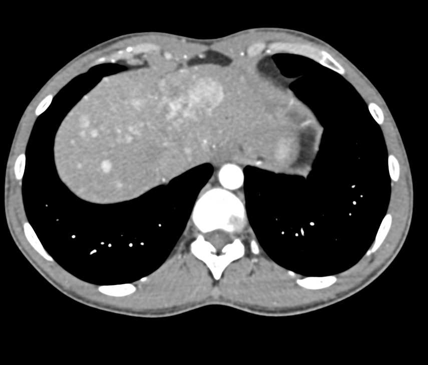 Neuroendocrine Tumor of the Pancreas with Vascular Liver Metastases - CTisus CT Scan