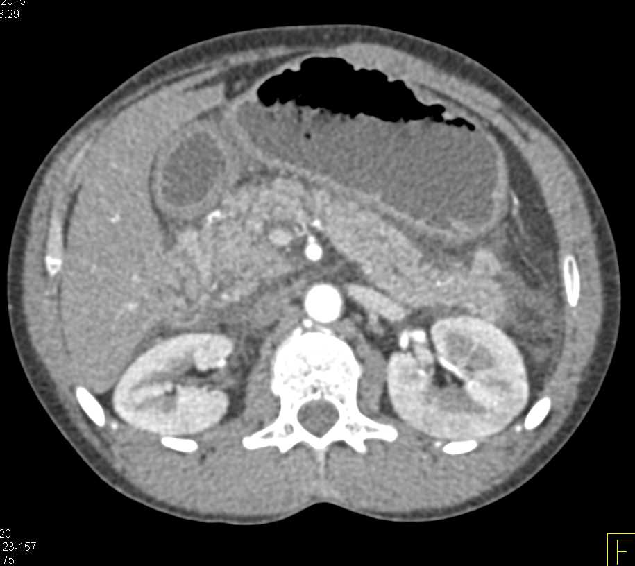 Autoimmune Pancreatitis - CTisus CT Scan