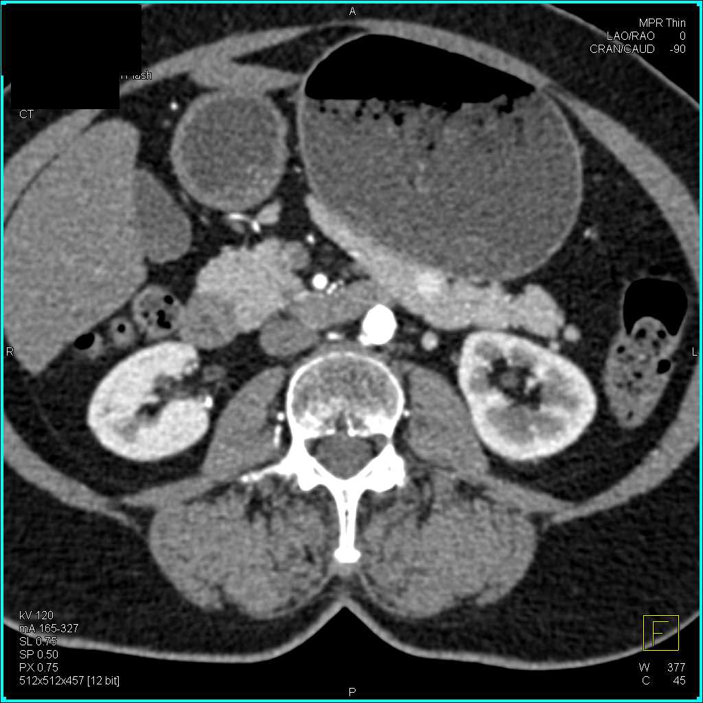 1cm Neuroendocrine Tumor in the Body of the Pancreas - CTisus CT Scan