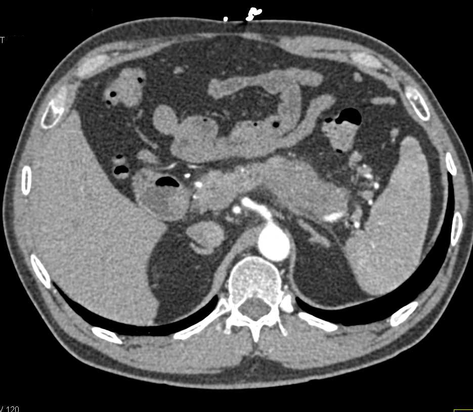 Autoimmune Pancreatitis Simulates a Pancreatic Cancer - CTisus CT Scan