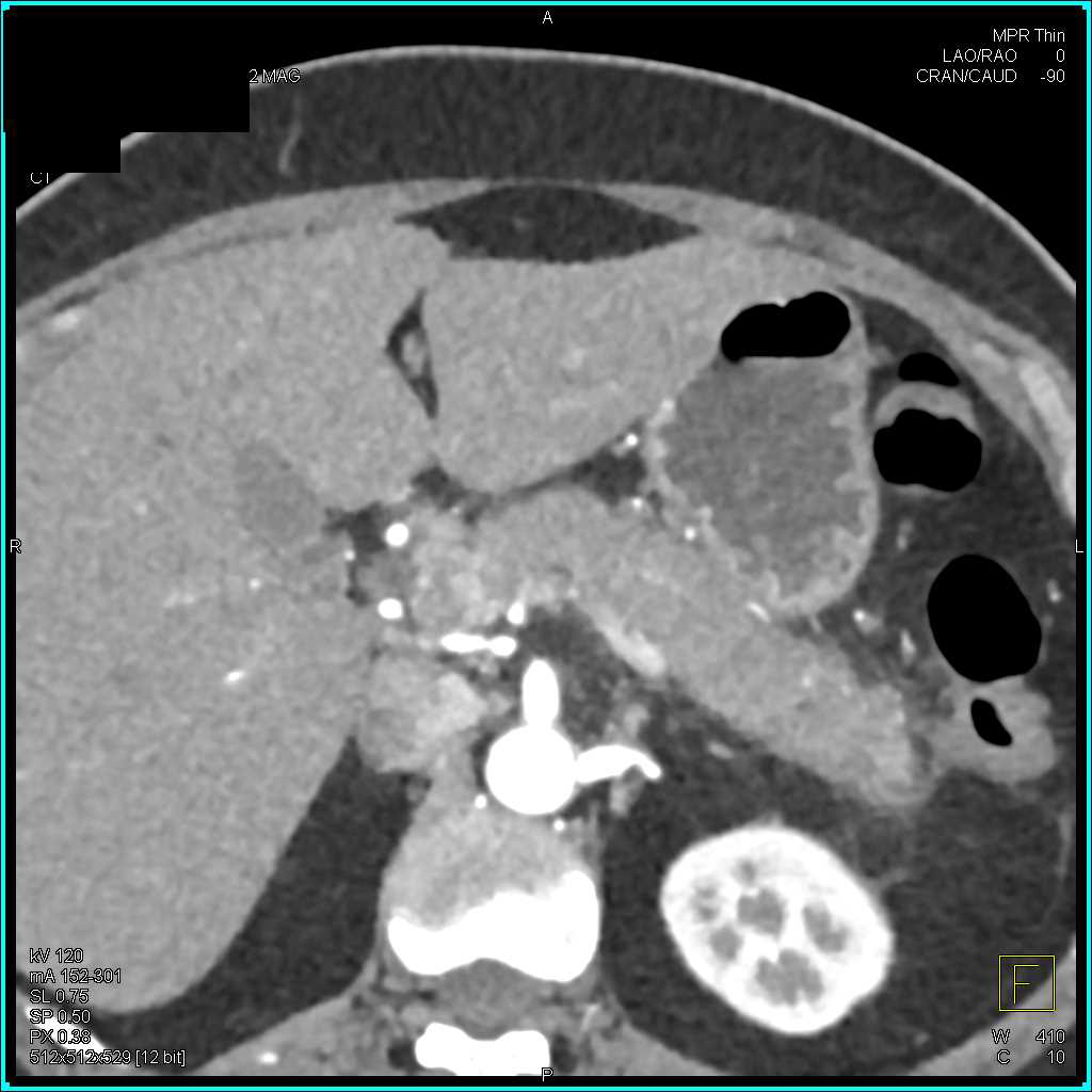 Autoimmune Pancreatitis Simulates a Pancreatic Cancer - CTisus CT Scan