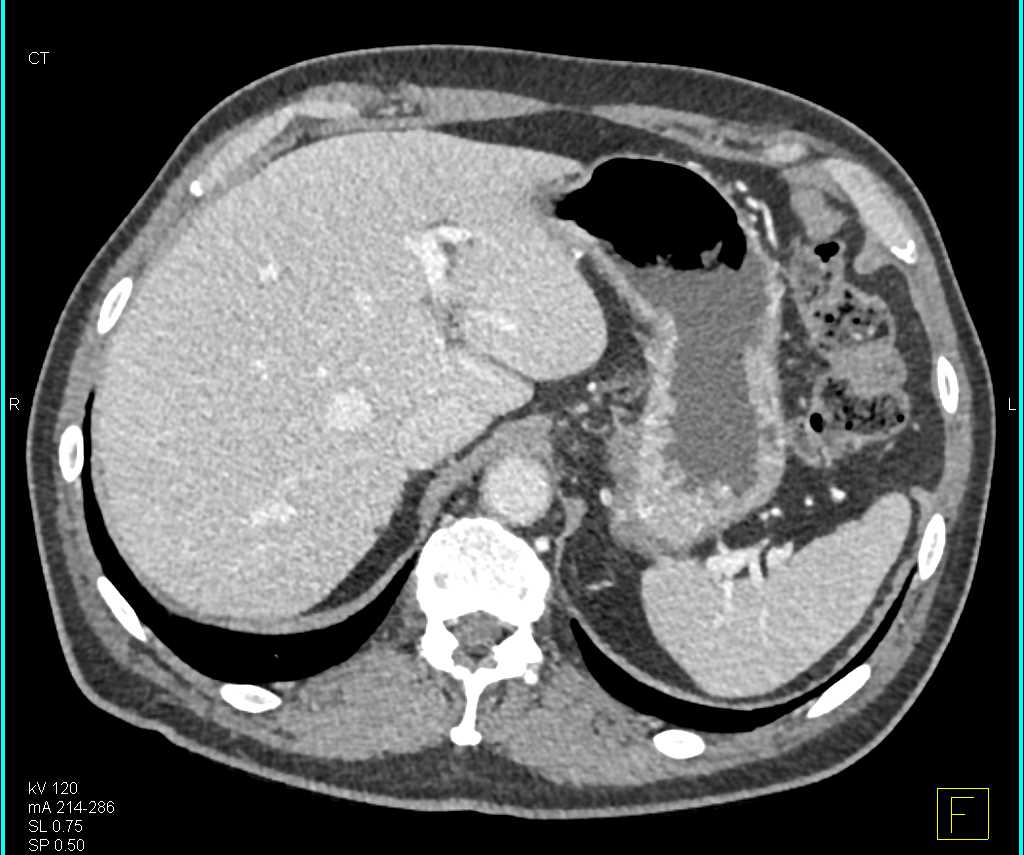 CT Case Studies Insulinoma 1 cm Tail of Pancreas