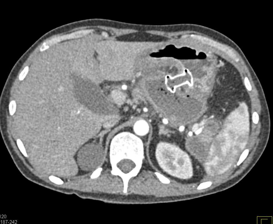 Pancreatitis with Pseudocyst Treated with Cystogastrostomy - CTisus CT Scan