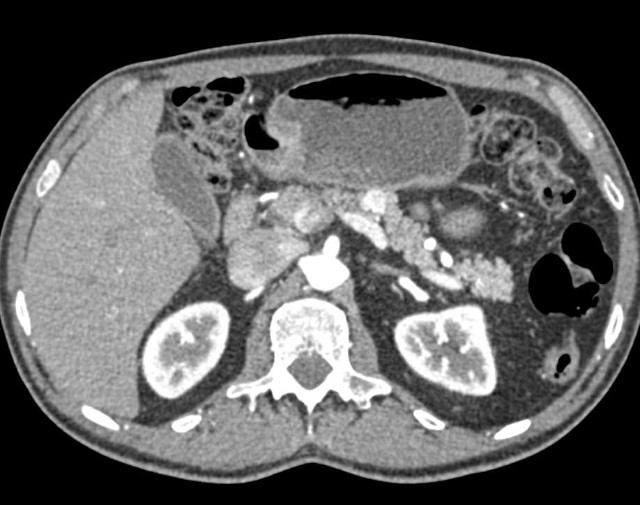 1cm Neuroendocrine Tumor Body of the Pancreas - CTisus CT Scan