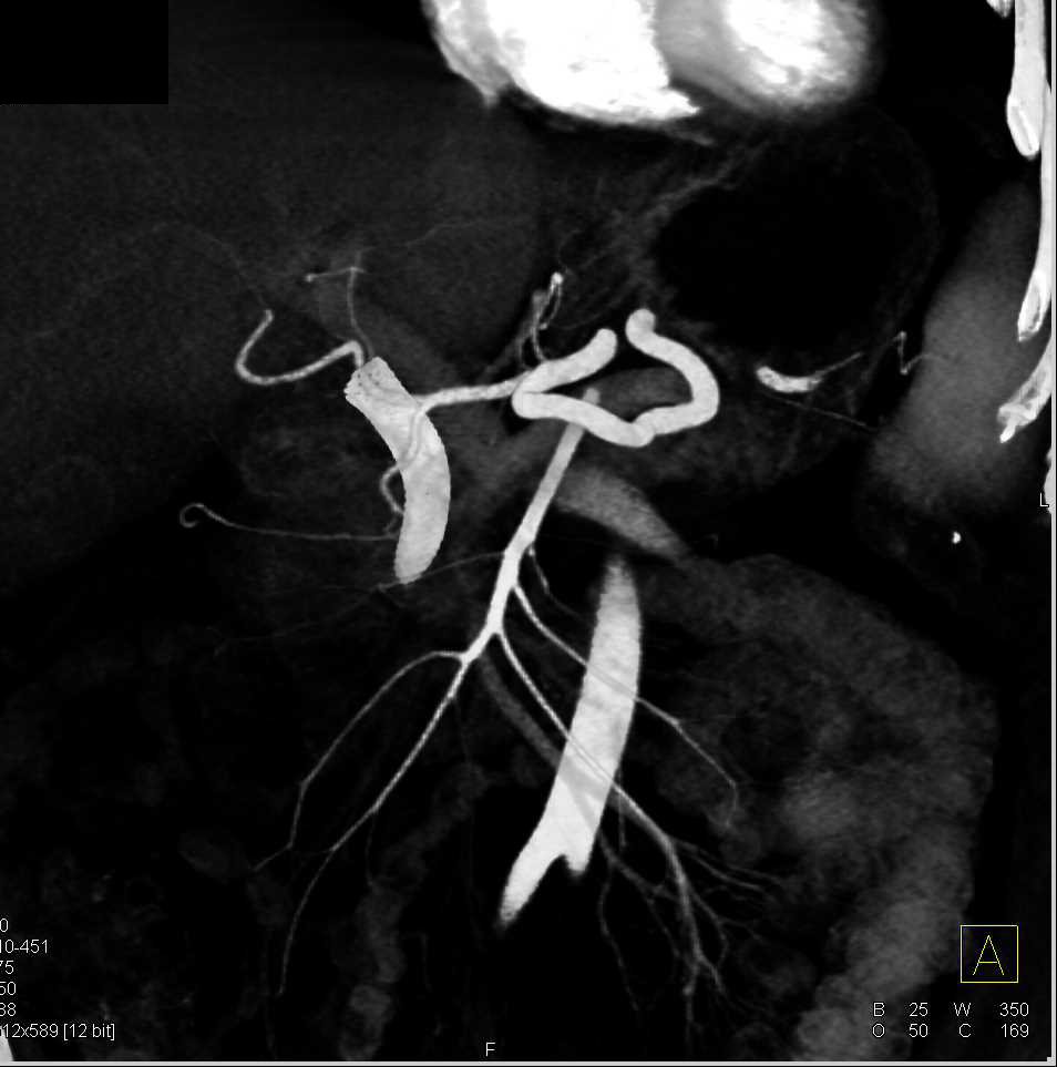 Pancreatic Adenocarcinoma Invades Superior Mesenteric Artery (SMA)/Celiac and PV/Superior Mesenteric Vein (SMV) - CTisus CT Scan