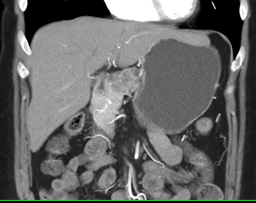 Serous Cystadenoma - CTisus CT Scan