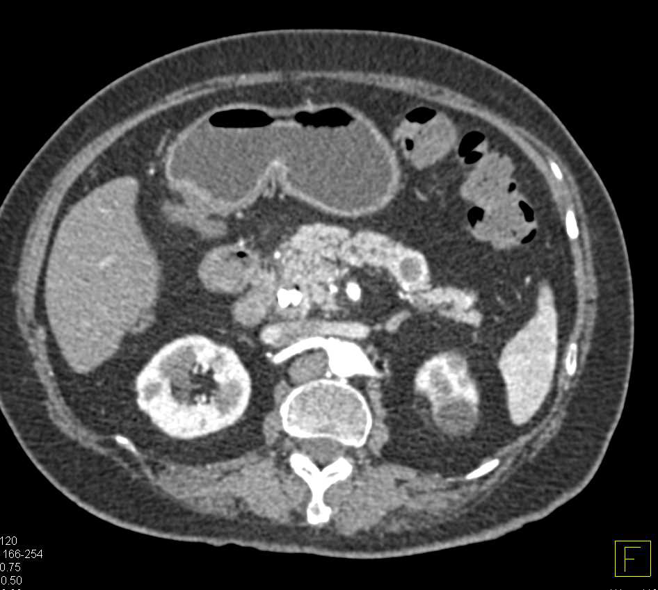 Cystic Neuroendocrine Tumor - CTisus CT Scan