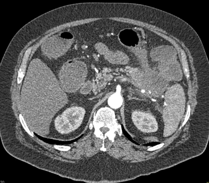 Invasive Carcinoma Tail of the Pancreas - CTisus CT Scan