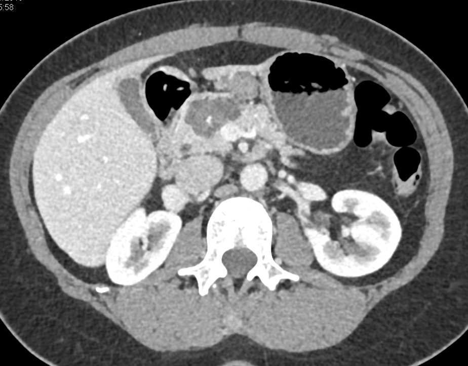 Serous Cystadenoma Pancreas - CTisus CT Scan