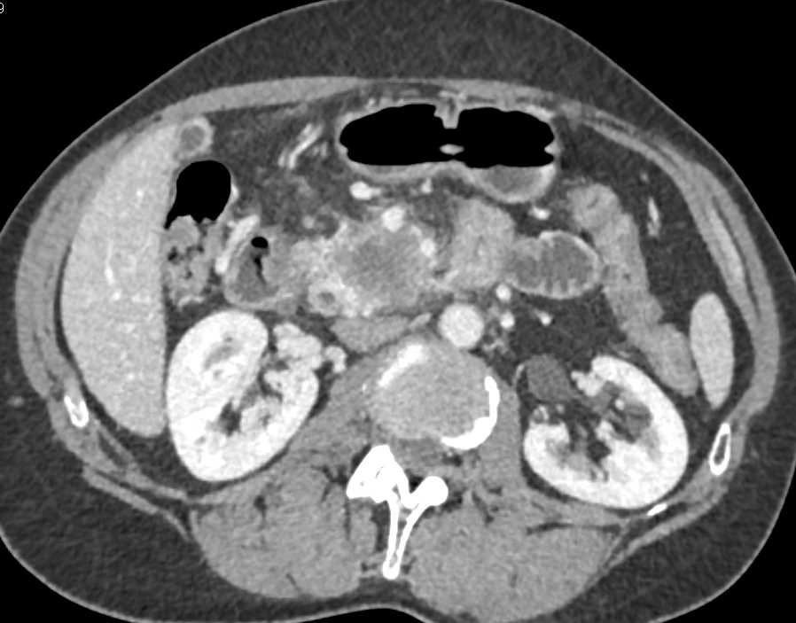 Adenocarcinoma Head of Pancreas with Vascular Invasion - CTisus CT Scan