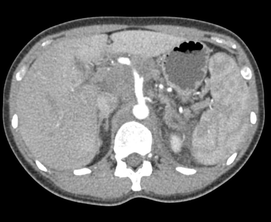 Pancreatic Adenocarcinoma with Extensive Adenopathy, Liver Metastases and Vascular Invasion - CTisus CT Scan