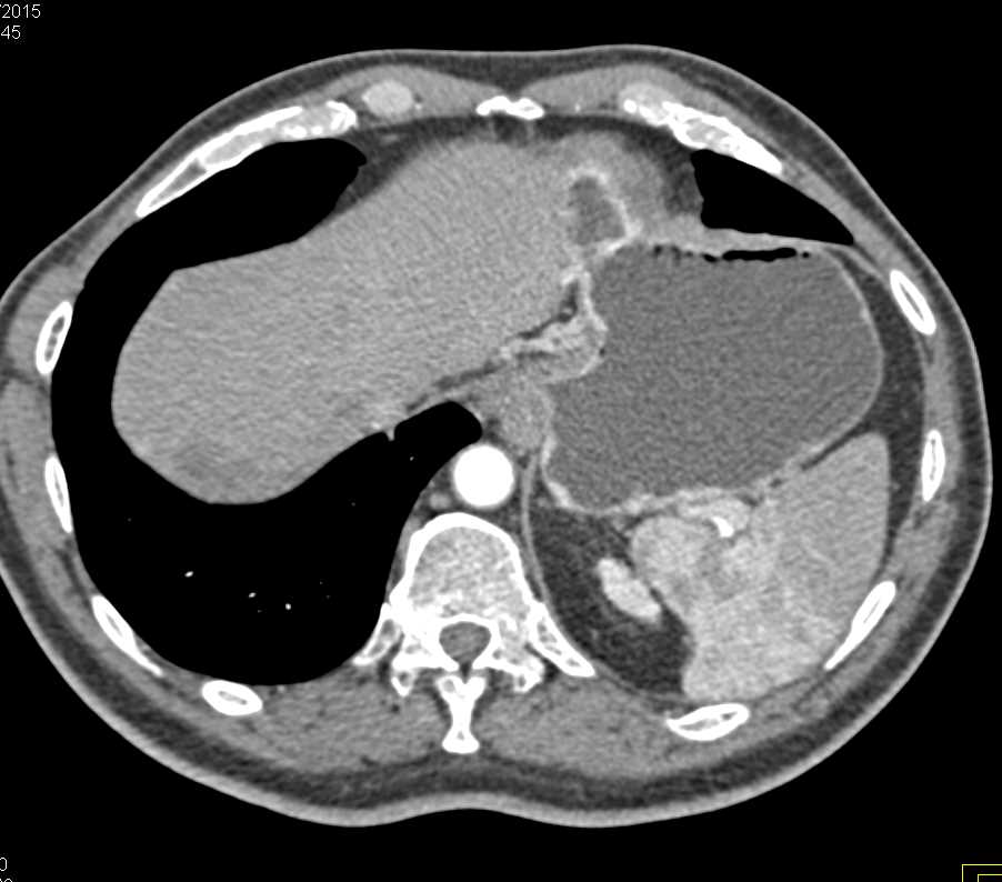 Carcinoma Tail of the Pancreas with Liver Metastases - CTisus CT Scan