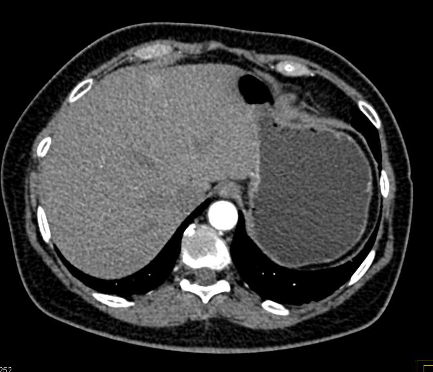 Neuroendocrine Tumor Head of the Pancreas - CTisus CT Scan