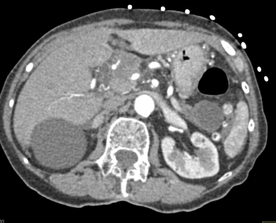 Carcinoma Head of Pancreas Invades Duodenum and Local Vasculature - CTisus CT Scan