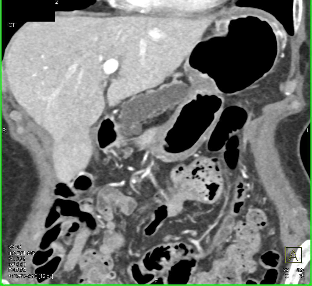 Main Duct Intraductal Papillary Mucinous Neoplasm (IPMN) - CTisus CT Scan