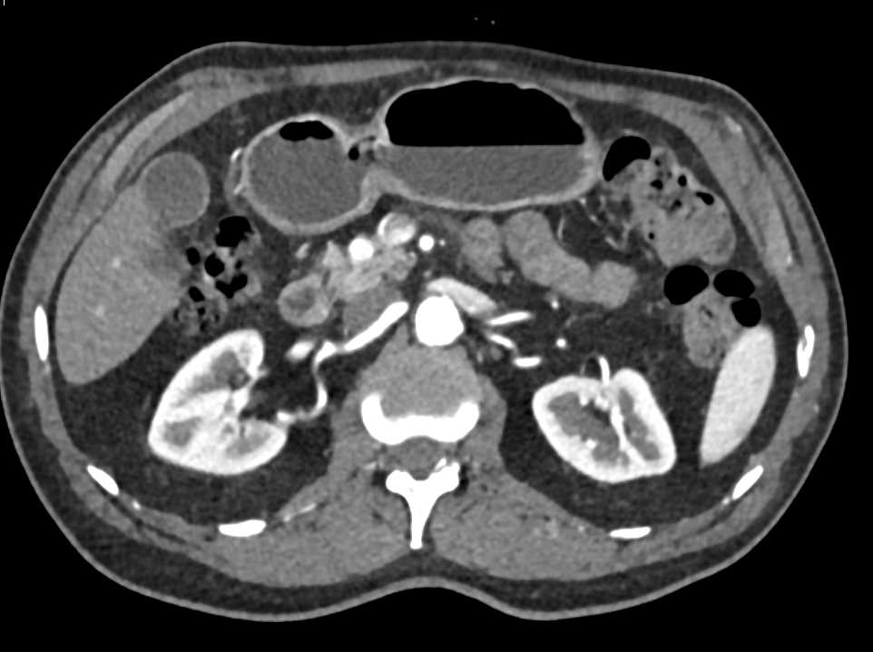 1 cm Pancreatic Neuroendocrine Tumor (PNET) in the Head of the Pancreas - CTisus CT Scan