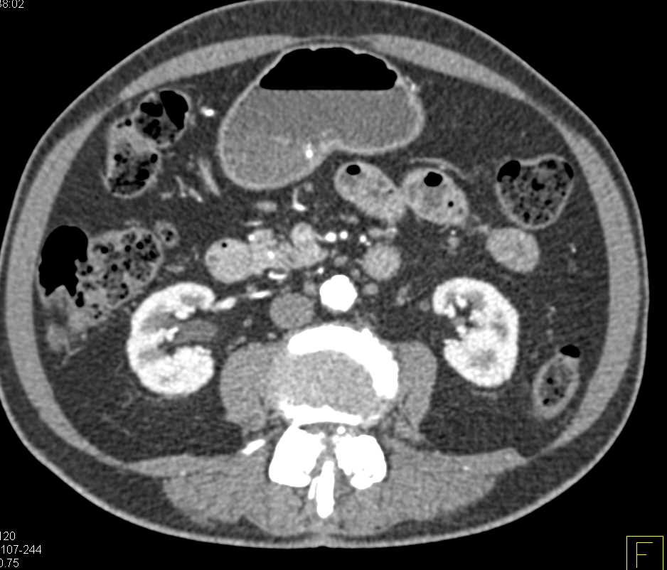 Multiple Neuroendocrine Tumors in the Pancreas - CTisus CT Scan