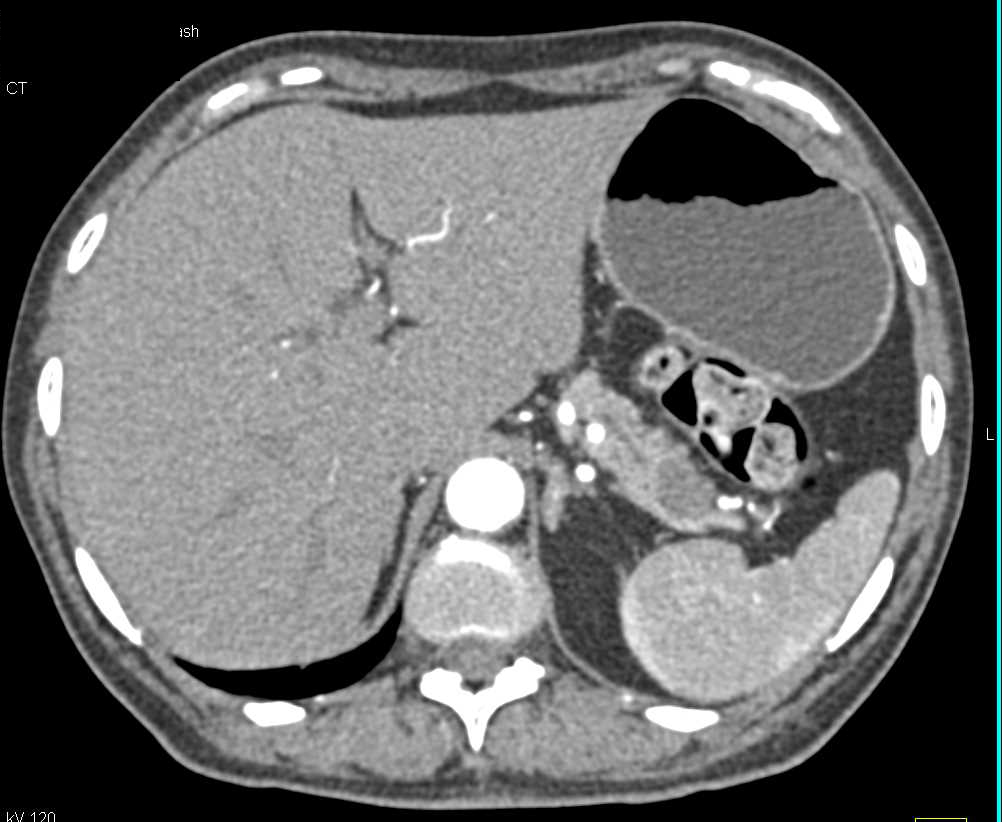 Intraductal Papillary Mucinous Neoplasm (IPMN) Tail of Pancreas - CTisus CT Scan